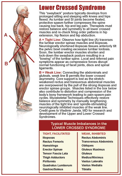 Crossed Syndromes