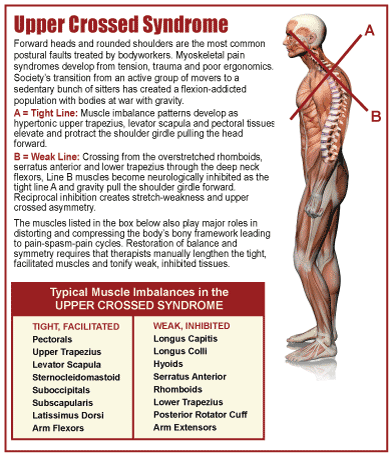 horní zkřížený syndrom z http://www.mbmyoskeletal.com