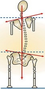 Leg Length Discrepancy 