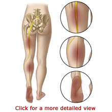 What is the sciatic nerve?